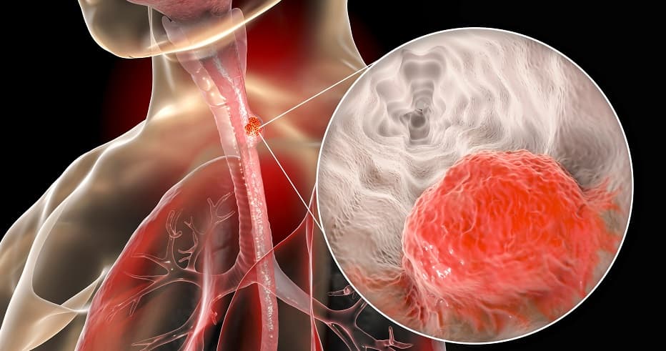 Nivolumab receives FDA approval for esophageal squamous cell carcinoma