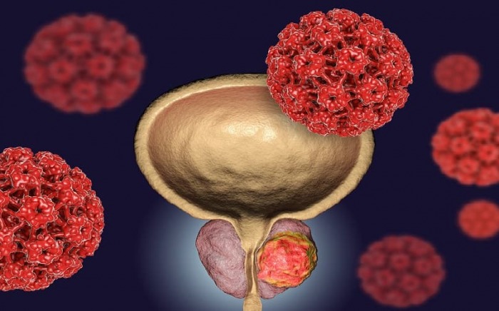 Novel Guidelines for Treating Advanced Prostate Cancer
