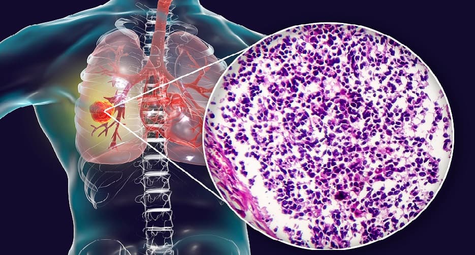 Pyrotinib could be the choice of drug in chemotherapy treated HER2-mutant NSCLC patients