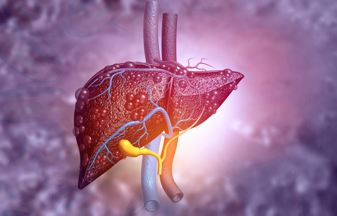 Natural ways to prevent liver cancer