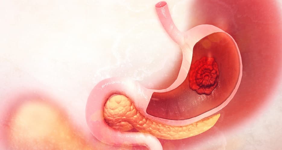 Ways to reduce the risk of Stomach Cancer