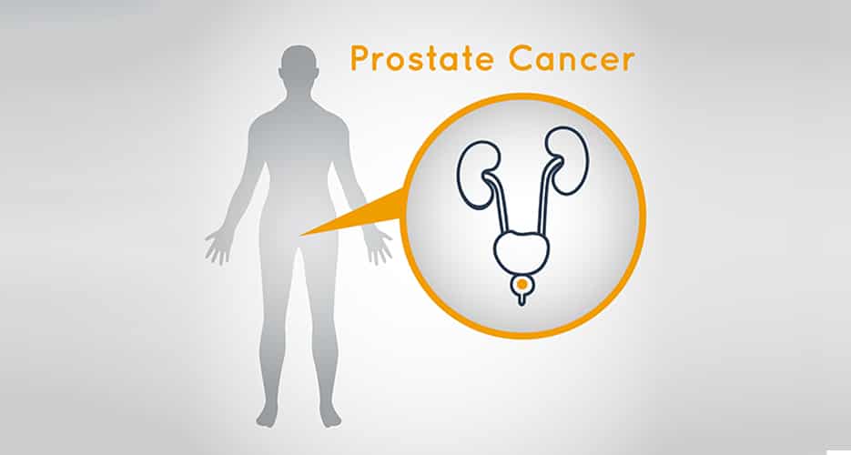 Right treatment sequence of Abiraterone Acetate-Prednisone and Enzalutamide for Prostate Cancer