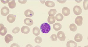 Axicabtagene-ciloleucel-to-treat-Follicular-Lymphoma-admac