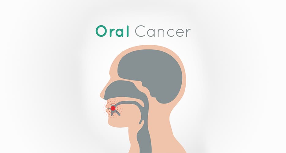 10 Ways to Prevent Oral Cancer Risk
