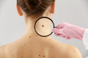 skin-cancer-9-myths-and-facts