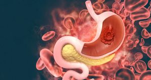 Pembrolizumab-receives-FDA-accelerated-approval-to-treat-HER2-positive-gastric-cancer